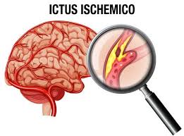 O confermare l'emorragia subaracnoidea o definire il pattern e l'entità della. Ictus Sintomi Cause E Riabilitazione Santo Stefano Riabilitazione