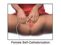 Urinary Catheterization Wikipedia