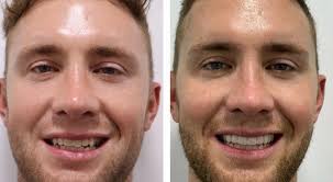 Dr Clint Hazell 📍L7 201 Wickham Tce, Spring Hill QLD 4000 Tel: 3180 1156  Treatment time: 6 months Procedure: Full Mouth Rehab Dental Fee Estimate:  $30,000