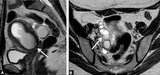 Stage iv or severe stage: Mr Imaging Of Endometriosis Spectrum Of Disease Sciencedirect