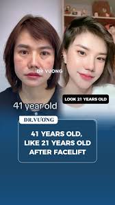 Understanding Facelifts: Results and Insights from Experts