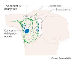 When it comes to the breast cancer statistics, about 1 in. Stage 3 Breast Cancer Cancer Research Uk