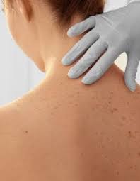 There is more what we do! What Is The Treatment For Skin Cancer Anca Breahna