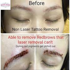 It helps to detox the body and the pigment get dissolved with the sweat and comes on the surface. Non Laser Tattoo Removal