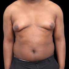 Image result for Gynecomastia