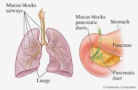 Cystic fibrosis is an autosomal recessive disorder, and most carriers of the gene are asymptomatic. Cystic Fibrosis