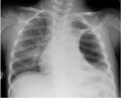 Image result for Pneumothorax