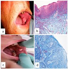 Image result for papillomavirus tongue)