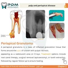 Image result for granuloma gum disease