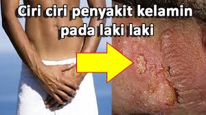 Masalah ini menjadi lebih buruk karena lebih sedikit remaja dari pada wanita yang lebih dewasa mencari perawatan sebelum melahirkan (prenatal) dan layanan kesehatan reproduksi untuk pengobatan infeksi ini. Ciri2 Gejala Penyakit Raja Singa Pada Perempuan Dan Apa Obatnya Youtube