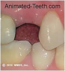 D It S In The Process Of Being Fully Replaced By Granulation Tissue This Is A Primordial In 2021 Wisdom Teeth Removal Food Tooth Extraction Tooth Extraction Healing