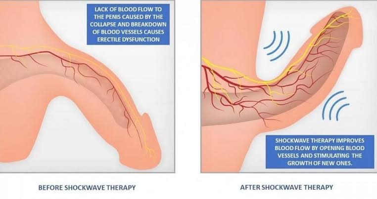 The Biological Impact of Shockwave Therapy on Penile Blood Flow, AI generated