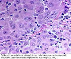 The accuracy of the pathological diagnosis is very important to the patients because they can be receive official compensation or relief when the diagnosis of. Pathology Outlines Mesothelioma Peritoneum Epithelioid