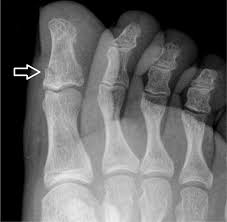 Check spelling or type a new query. Diagnosis And Management Of Common Foot Fractures American Family Physician