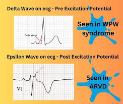 Image result for Epsilon Wave