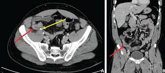 Ct scans and mri scans are two medical imaging methods that create detailed images of internal body parts, including bones, joints, and organs. When Is Contrast Needed For Abdominal And Pelvic Ct Cleveland Clinic Journal Of Medicine