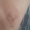 This is my final video in my laser for pigmentation removal experience. Https Encrypted Tbn0 Gstatic Com Images Q Tbn And9gcs1picxjgdk0leeohly7 Aik4tjdepsibwtev 4jy8 Usqp Cau