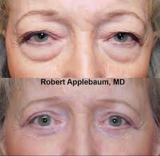 BEST eyelid lift surgeon in PENSACOLA…..Go!