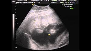 Desarrollo de tu bebé tu bebé esta semana se ve como un recién nacido, pero en miniatura. Ultrasonido Bebe 22 Semanas Youtube