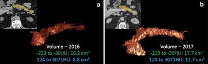 Sleisenger and fordtran's gastrointestinal and liver disease: Advanced Imaging Techniques For Chronic Pancreatitis Springerlink