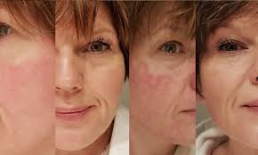 15.06.2009 2009 hud & hår. Sminke Pa Veldig Rod Hud Og Rosacea Toneskipa No