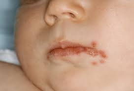 Image result for newborn diaper rash