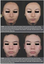 A 7-Week, Open-Label Study Evaluating the Efficacy and Safety of  415-nm/633-nm Phototherapy for Treating Mild-to-Moderate Acne in  Adolescents and Adults