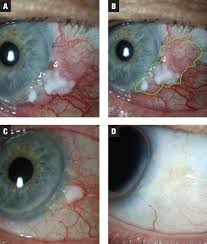 Image result for lesion sclera