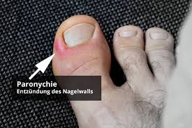 Nagelentzundung Nagelbettentzundung Ursachen Behandlung