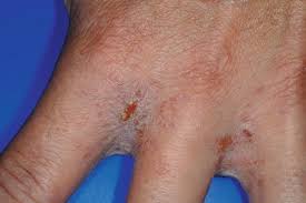 Image result for spinne biss haut reaktion