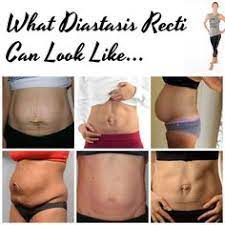 12 Best Umbilical Hernia Repair Ideas Umbilical Hernia Repair Umbilical Hernia Hernia Repair