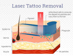 Before you begin to think of a laser as the magic wand of tattoo removal, you need to be aware that it's not a one and. Laser Tattoo Removal Remove Unwanted Tattoos Laserspa Of Tampa Bay