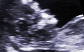 The scans are painless, have no known side effects on mothers or babies having a scan in pregnancy is usually a happy event, but be aware that ultrasound scans may detect some serious health conditions, so try to be. Fee For Ultrasounds Was A Barrier To Healthcare Midwife Says Rnz News