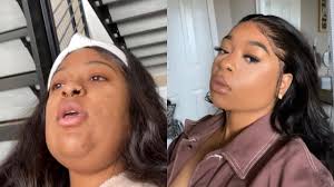 My Kybella experience and why I DONT recommend it (with pictures)