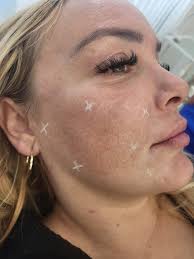 Today I have done my #polynucleotide #eyes and #face course ✨️ Better than  any lumi eyes or treatment or skin boosters