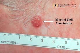 Image result for Merkel Cell Carcinoma