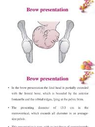 Image result for Brow Presentation