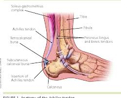 Achilles (calcaneal) tendon attaches the triceps surae to the calcaneus. Table 2 From Common Conditions Of The Achilles Tendon Semantic Scholar