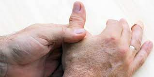 Tendovaginitis Stenosans De Quervain