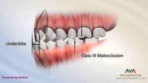 An underbite, called a class iii malocclusion or prognathism, is when the lower teeth and jaw protrude in front of the upper teeth. Class 3 Malocclusion Reddit Malocclusion Of Teeth