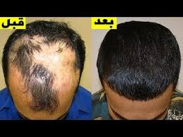 سبحان الله عشبة معجزة في إنبات الشعر وملء الفراغات والصلع وعلاج الثعلبة منذ أول استعمال Youtube Hair Transplant Hair Control Hair Treatment