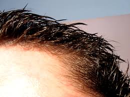 In this guide, we'll take a look at the science behind coconut oil as a hair health and hair loss prevention product, from its effects on reversing and treating hair damage to the potential for coconut oil to slow down or prevent hair loss. Coconut Oil For Hair Loss Natural And Healthy Living