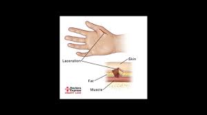 When your healthcare provider says it is okay to get out of bed, do not put pressure on your leg. How To Know If You Need Stitches Youtube