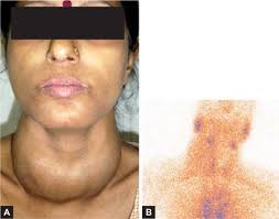Image result for Multinodular Goiter