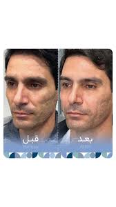 تزریق فول فیس فیلر , مهم‌ترین تغییری که باعث شادابی چهرشون شده چیه ؟ ,  ____________, جهت مشاوره و نوبت دهی با شماره های مطب در ارتباط باشید.,  🔹09303030712, 🔸09301808282, ♦️07136540410, ...