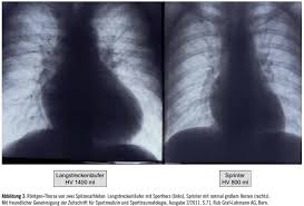 Ihr symptome sind häufig kaum zu erkennen, das erschwert eine schnelle diagnose. Die Physiologische Herzhypertrophie Sportherz