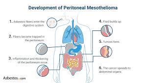 Sufferers of peritoneal mesothelioma may also experience pain in the abdominal area. Peritoneal Mesothelioma Causes Treatment Survival Rates