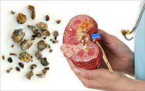 Hal ini penting dilakukan, terutama bagi pasien yang memiliki penyakit lain atau sudah minum. Diet Batu Ginjal Blog Ahligiziid