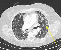 When helen began coughing up phlegm in january she thought she just had a chest infection. Cureus Nitrofurantoin Toxicity A Near Case Of Mistaken Identity