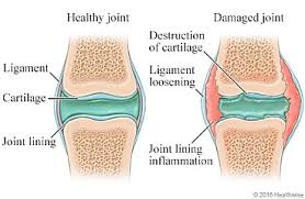 Image result for Septic Joint